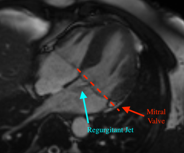 Illustration of the mitral valve and mitral regurgitation.